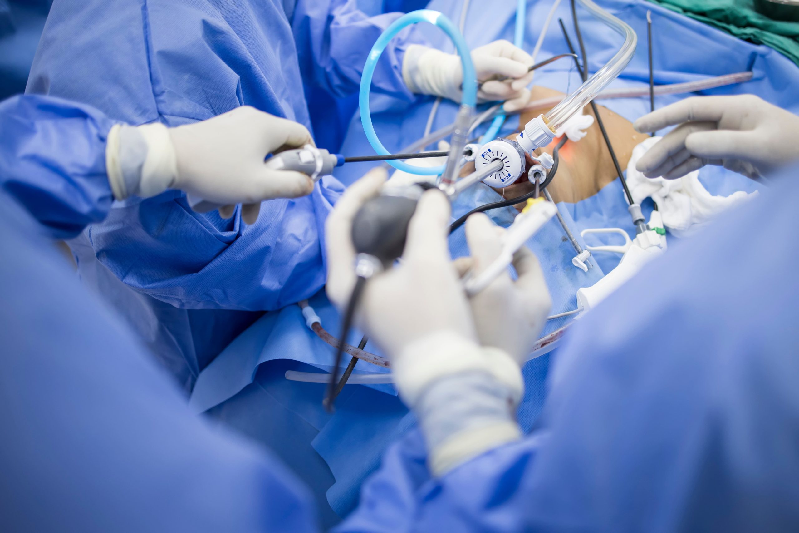 cirurgia bariátrica laparoscópica para obesidade