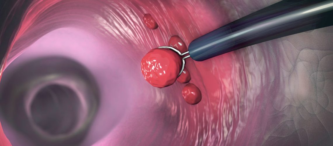 pólipos intestinais