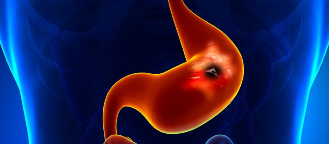 doenças oncológicas do aparelho digestivo