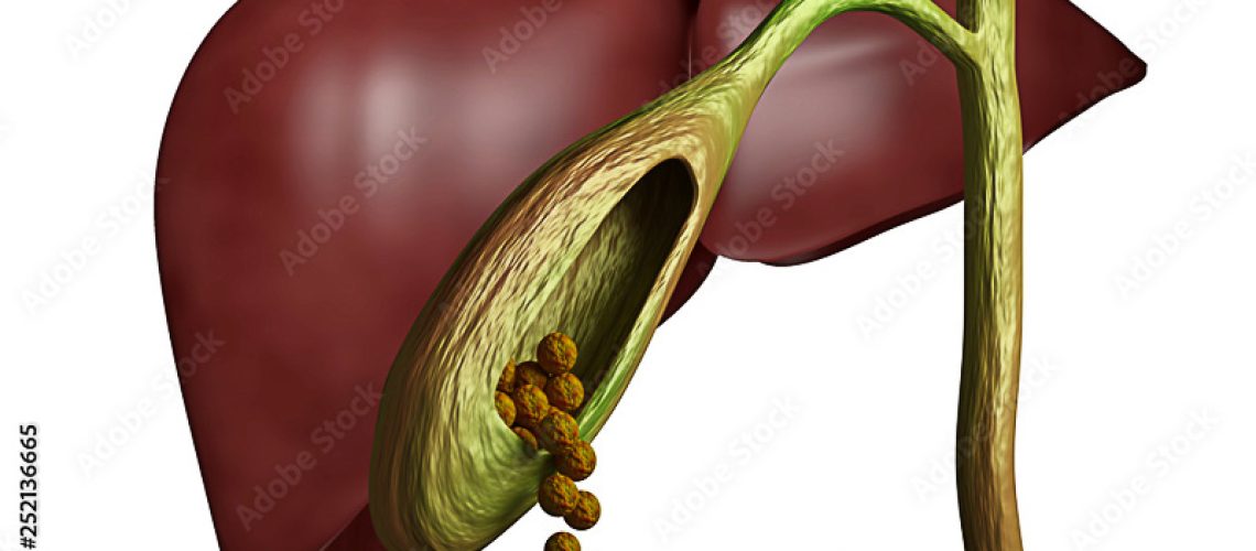 4-hábitos-que-podem-ajudar-na-formação-de-pedra-na-vesícula
