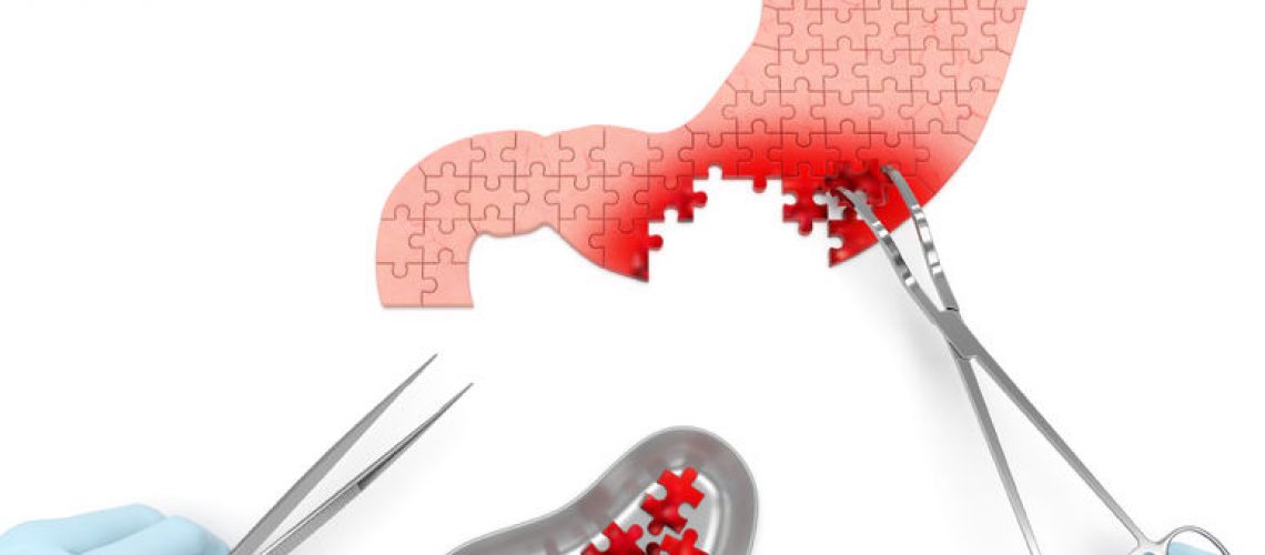 câncer de estômago