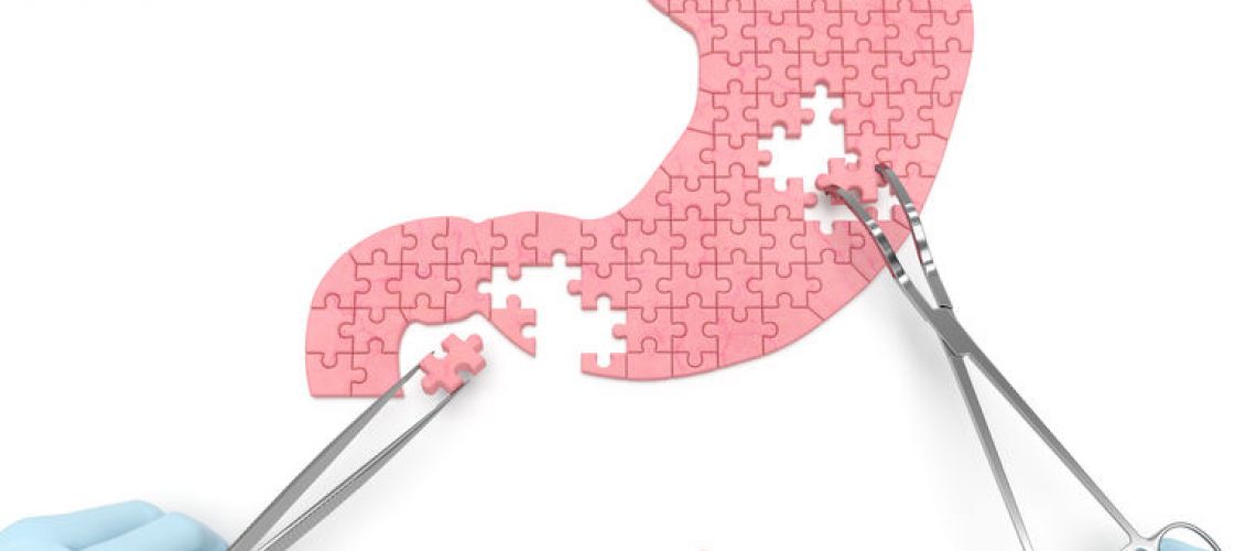 cirurgia bariátrica