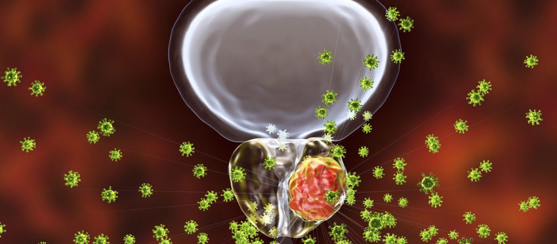 câncer de próstata