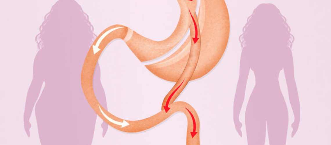 cirurgia bariátrica