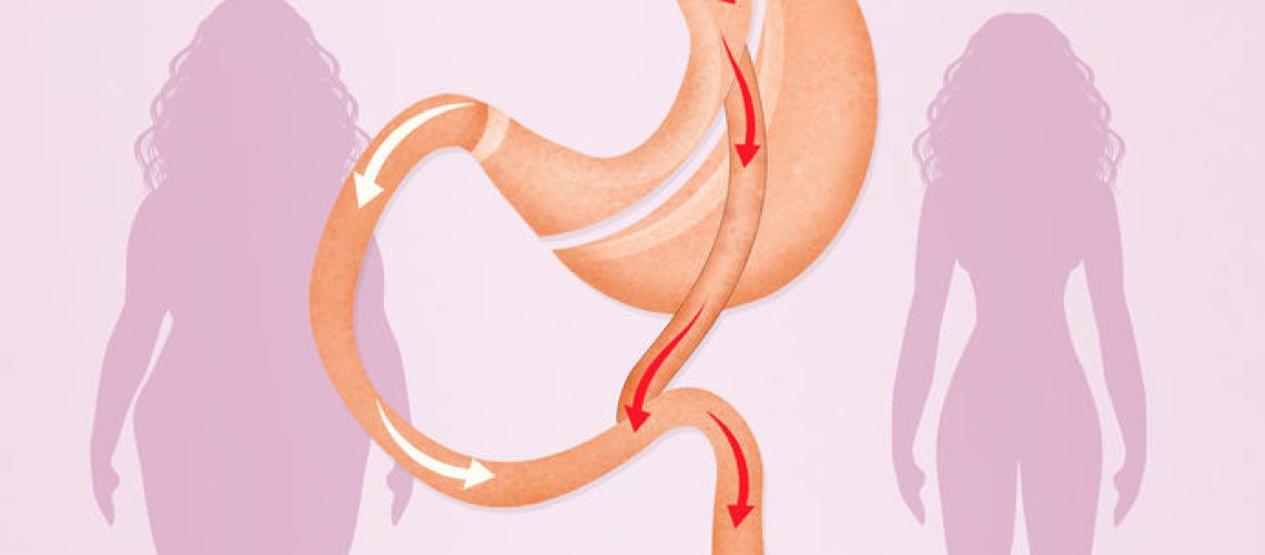 cirurgia bariátrica