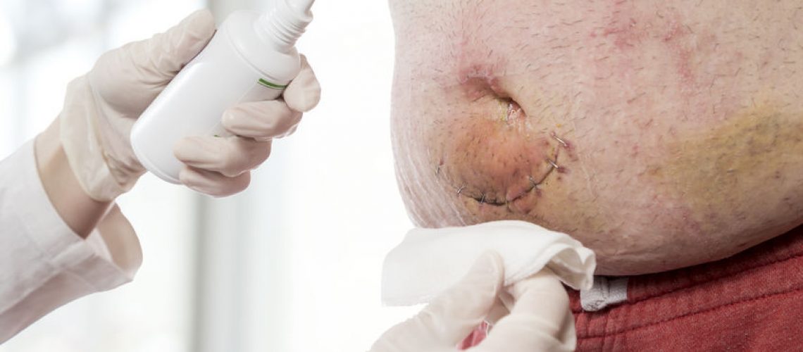 hérnia inguinal indireta