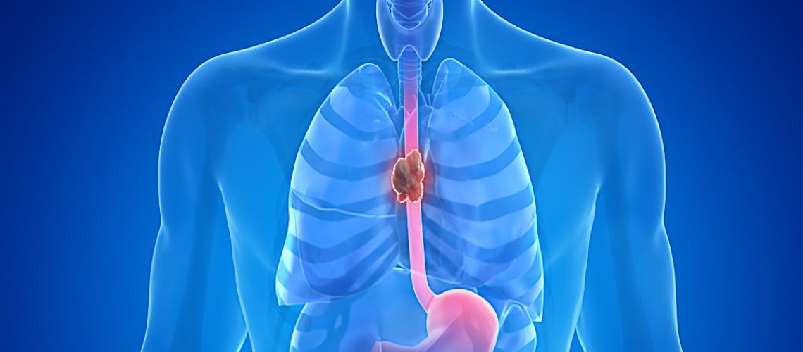 3d rendered medically accurate illustration of esophagus cancer