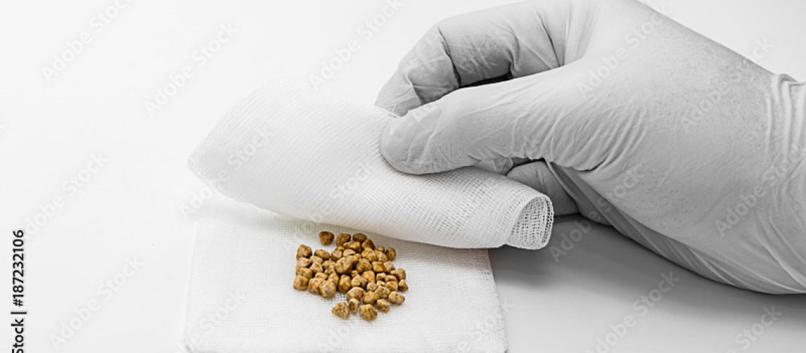 Cálculo na vesícula