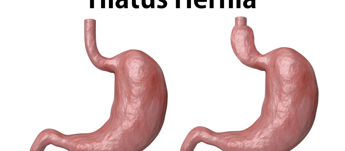 The hiatal hernia is the advancement of part of the stomach towards the esophagus, isolated over white background. 3D rendering