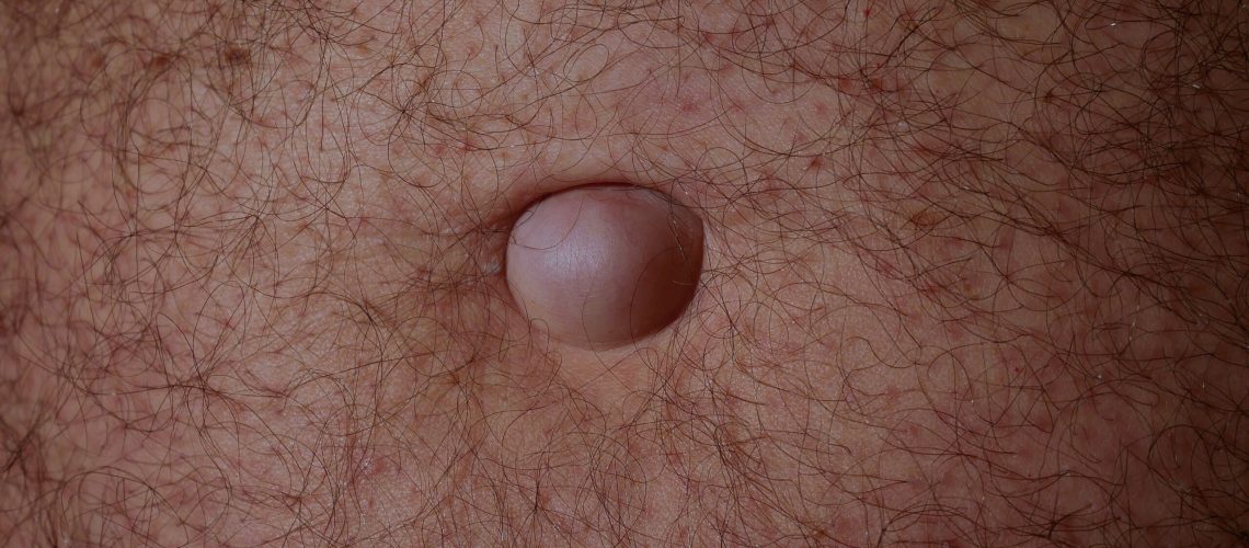 Medical examination of the patient's umbilical hernia of the abdomen. Medical photography