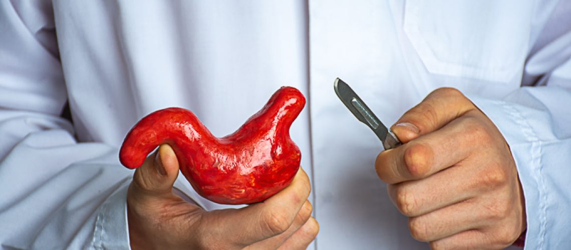 O Que É o Bypass Gástrico? Indicações e Procedimentos