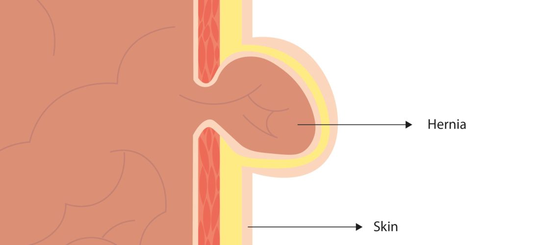 Umbilical hernia. Side view of an umbilical hernia with anatomical structures information
