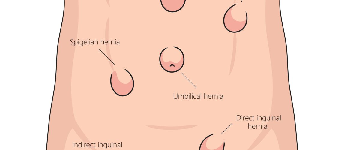 Human various hernia types on human abdomen for health and medical studies structure diagram hand drawn schematic raster illustration. Medical science educational illustration