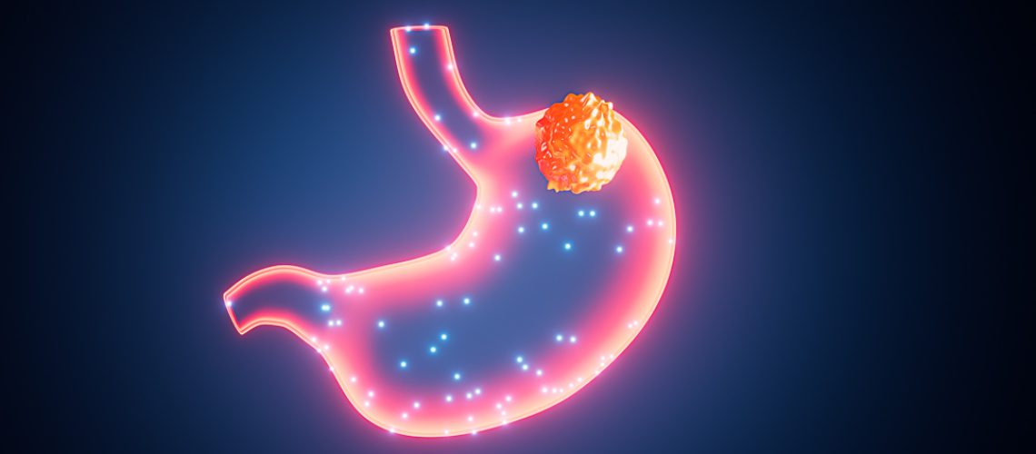 Human stomach cancer, gastric cancer, 3d rendering. Digital drawing.