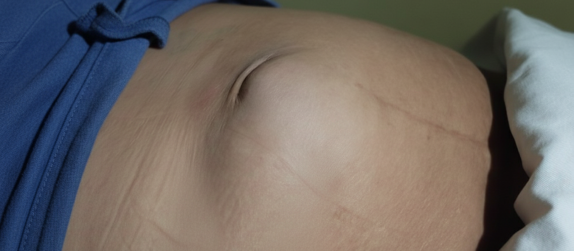 Hérnia Encarcerada e Estrangulada_ Entenda as Diferenças e Quando Procurar Ajuda Médica