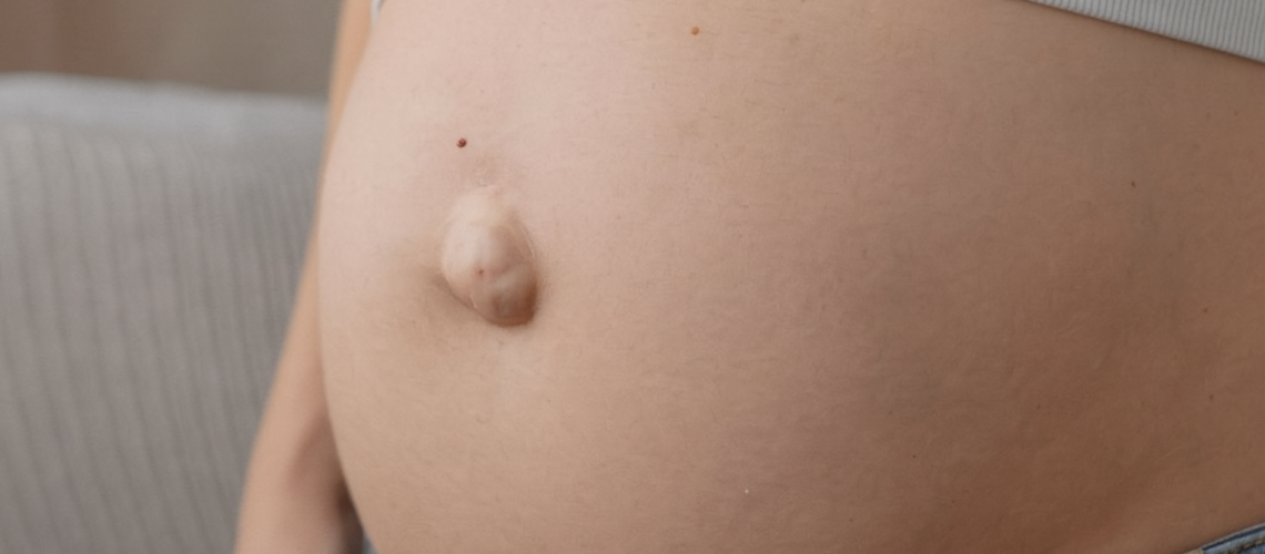 Hérnia Umbilical na Gravidez_ Como Identificar, Prevenir e Tratar