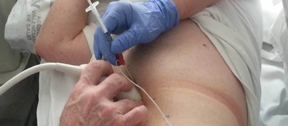 Toxina Botulínica no Tratamento de Hérnias Abdominais Complexas_ Mecanismos de Ação e Benefícios Clínicos