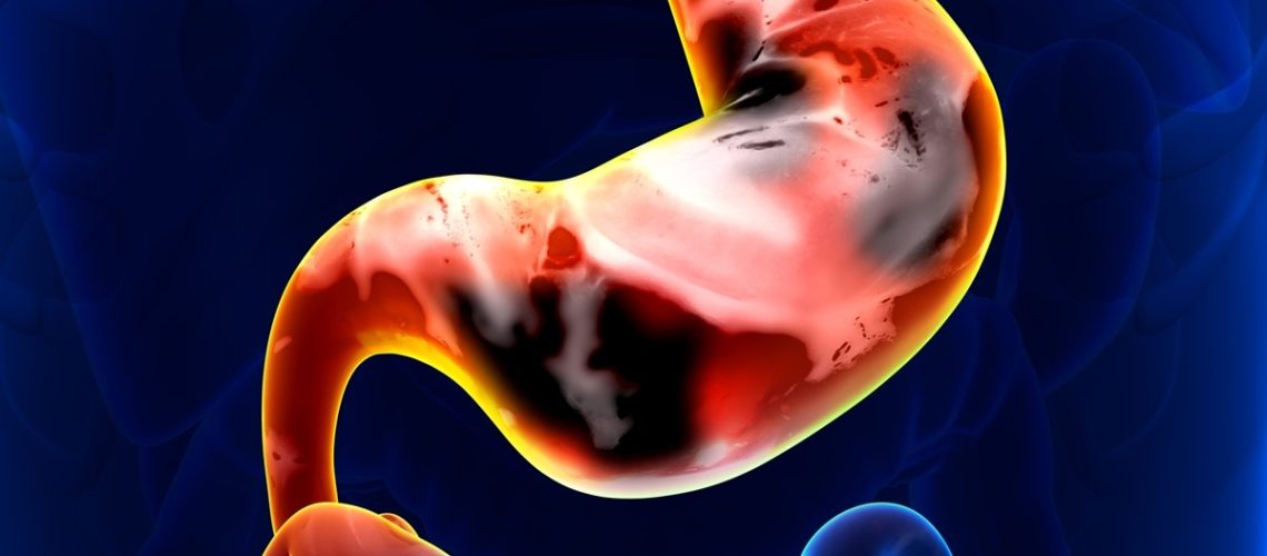 câncer de estômago