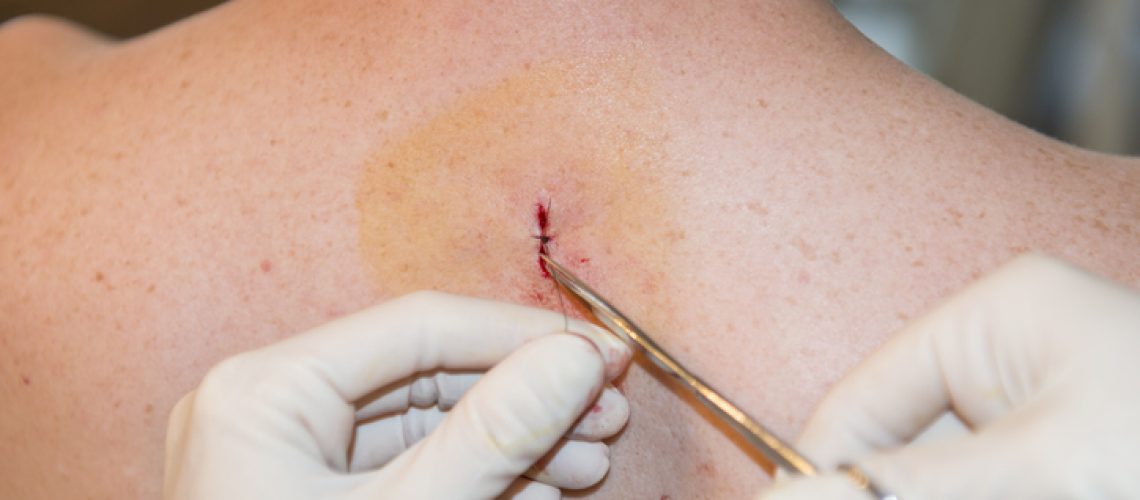 Carcinoma hepatocelular