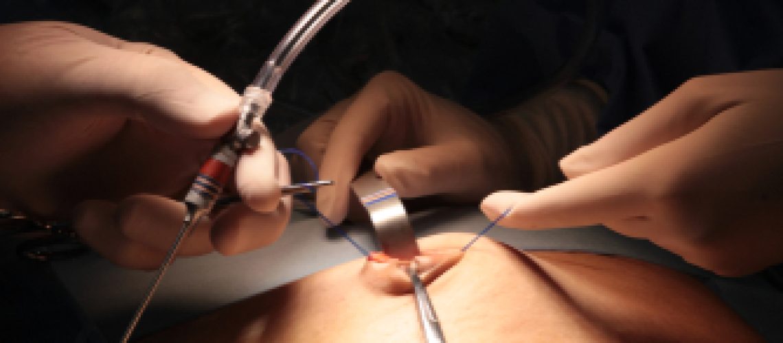 cirurgia bariátrica