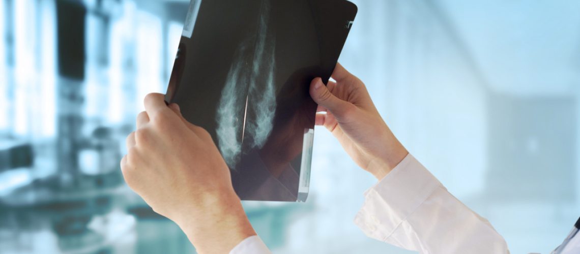 cirurgia para câncer de mama