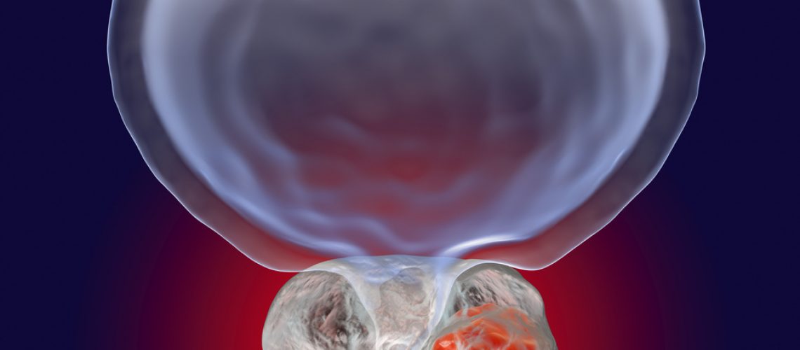 câncer de próstata