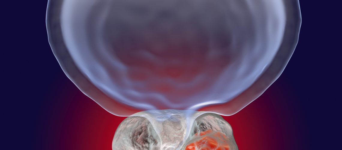 câncer de próstata